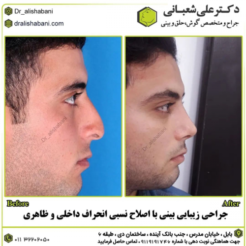 جراحی-بینی-در-بابل-417 (1)
