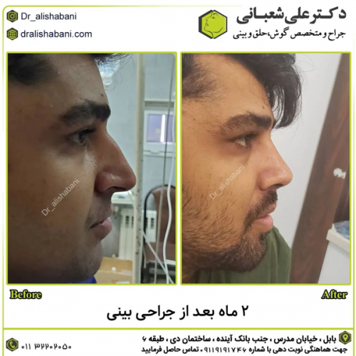 جراحی-بینی-در-بابل-418 (1)
