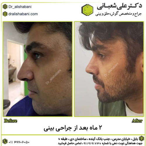 جراحی-بینی-در-بابل-419 (1)