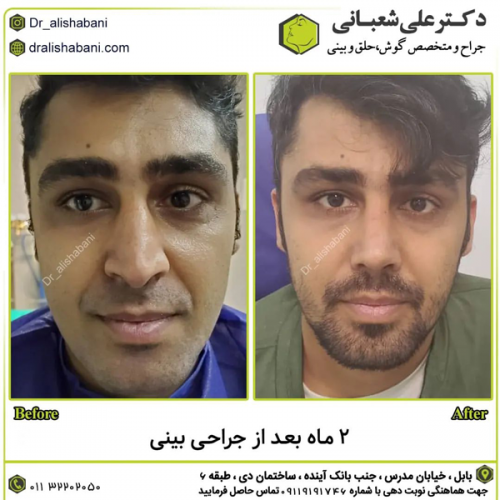 جراحی-بینی-در-بابل-420 (1)