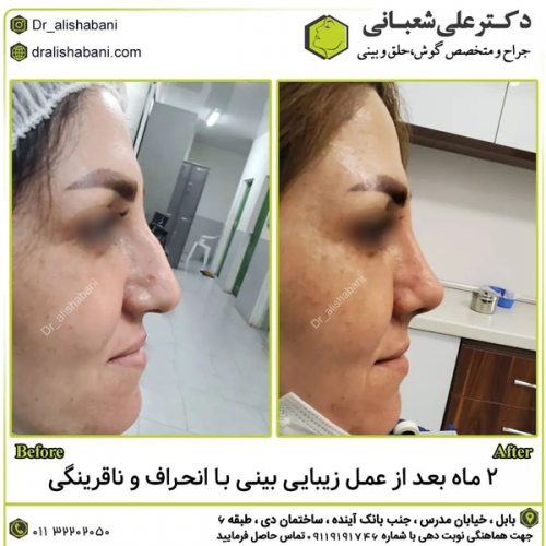 جراحی-بینی-در-بابل-422 (1)