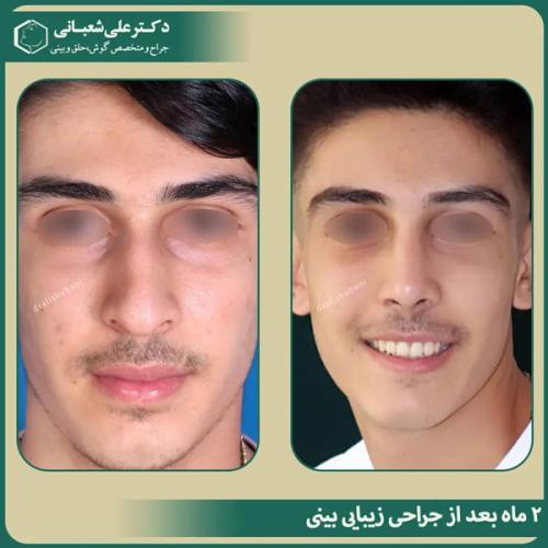 جراحی-بینی-در-بابل-476