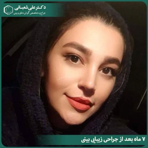 جراحی-بینی-در-بابل-477
