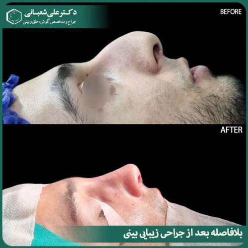 جراحی-بینی-در-بابل-479