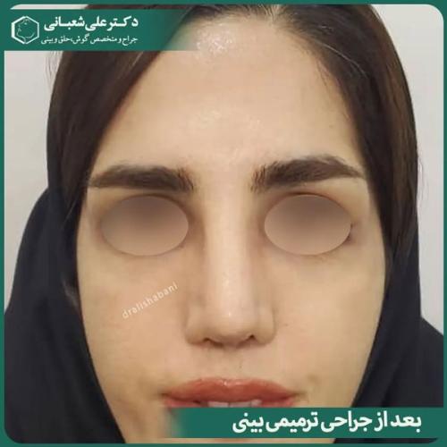 جراحی-بینی-در-بابل-480