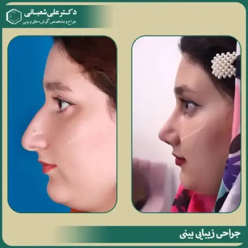 جراحی-بینی-در-بابل-481