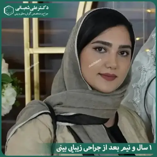 جراحی-بینی-در-بابل-484