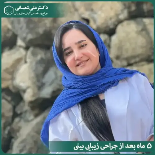 جراحی-بینی-در-بابل-486