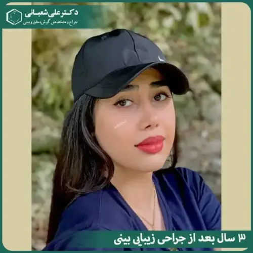 جراحی-بینی-در-بابل-487