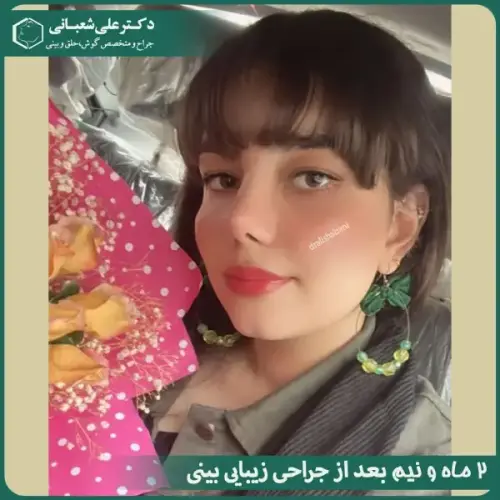 جراحی-بینی-در-بابل-488