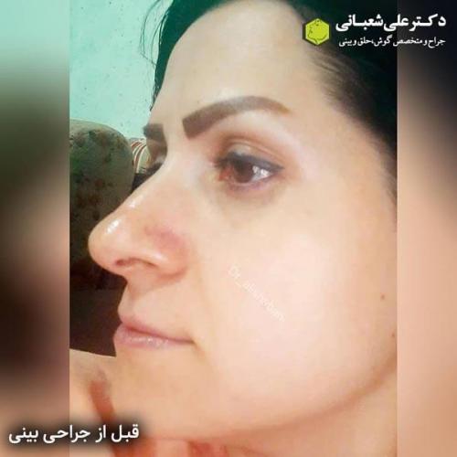 جراحی بینی 600 (148).jpg