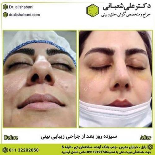 جراحی بینی 600 (150).jpg