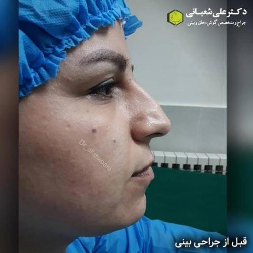 جراحی بینی 600 (165).jpg