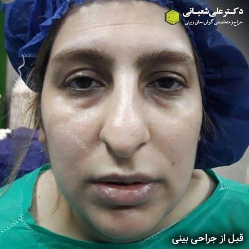 جراحی بینی 600 (174).jpg
