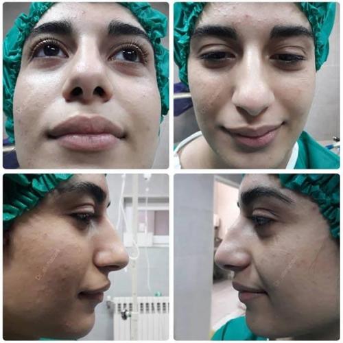 جراحی بینی در بابل 15.jpg