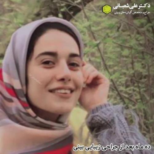 جراحی بینی در بابل 16.jpg