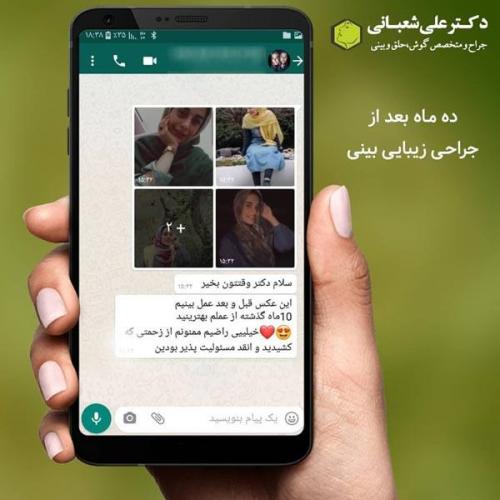 جراحی بینی در بابل 17.jpg