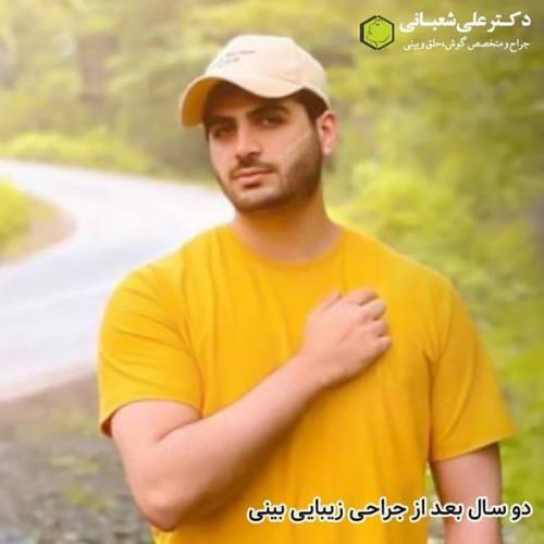 جراحی بینی در بابل 18.jpg