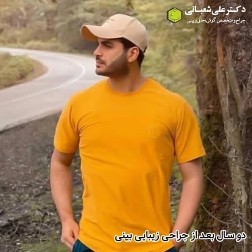 جراحی بینی در بابل 20.jpg