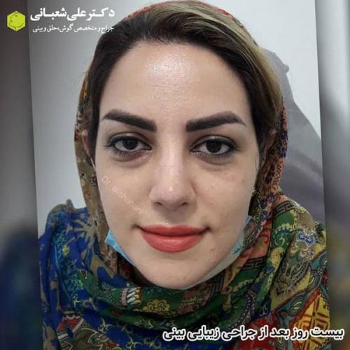 جراحی بینی در بابل 35.jpg