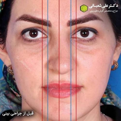 جراحی بینی در بابل 36.jpg