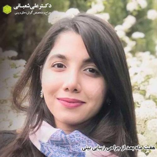 جراحی بینی در بابل 38.jpg