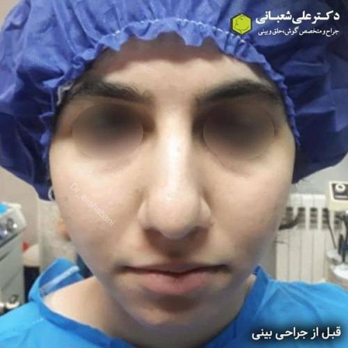 جراحی بینی در بابل 39.jpg