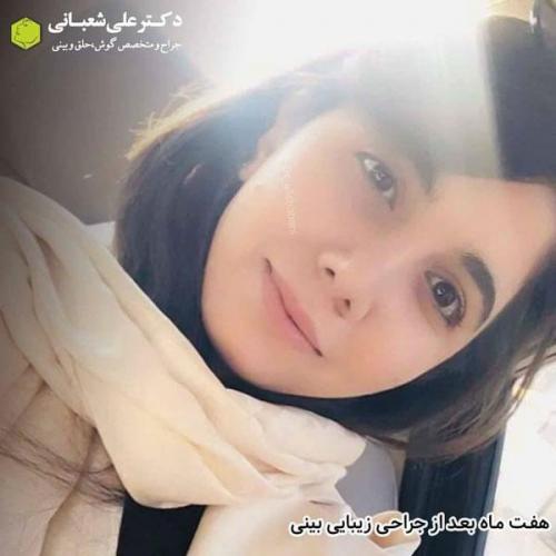 جراحی بینی در بابل 40.jpg
