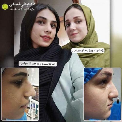 جراحی بینی در بابل 55.jpg