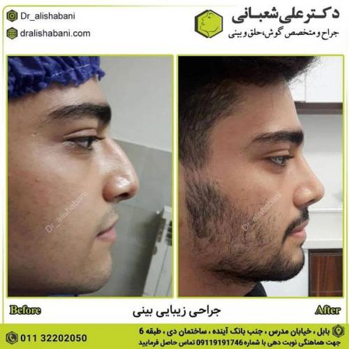 جراحی بینی در بابل 56.jpg