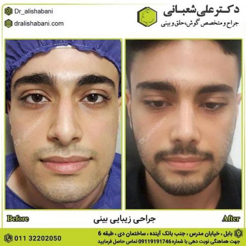 جراحی بینی در بابل 57.jpg
