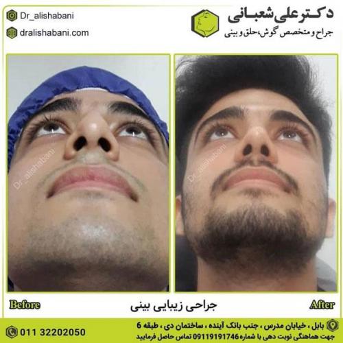 جراحی بینی در بابل 58.jpg