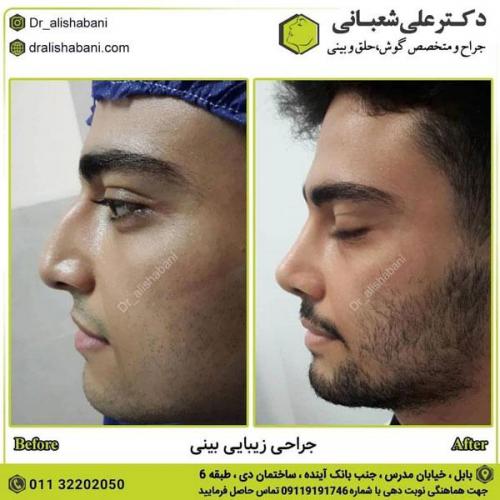 جراحی بینی در بابل 59.jpg