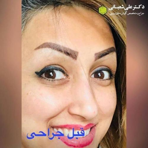 جراحی بینی در بابل 72.jpg