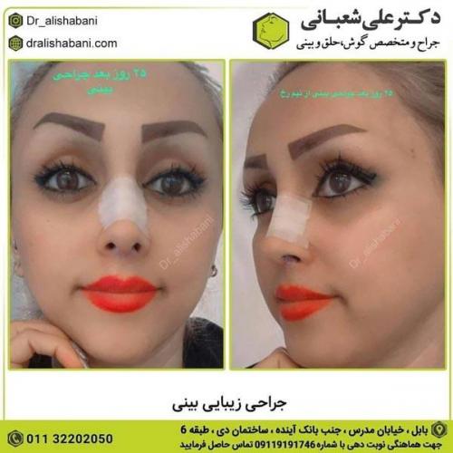 جراحی بینی در بابل 73.jpg