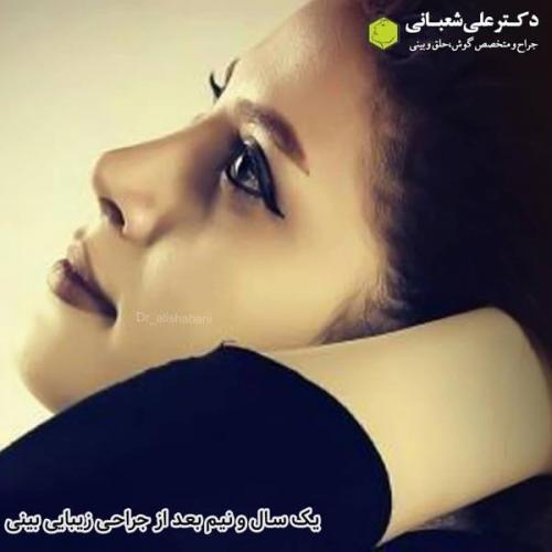 جراحی بینی در بابل 75.jpg