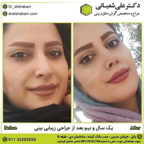 جراحی بینی در بابل 76.jpg