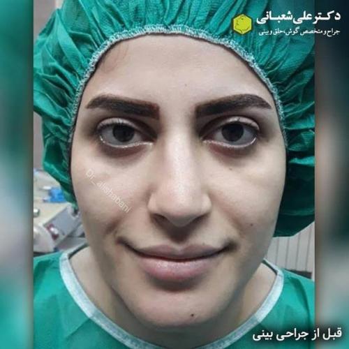 جراحی بینی در بابل 77.jpg