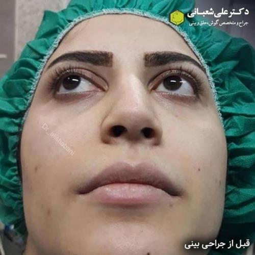 جراحی بینی در بابل 80.jpg