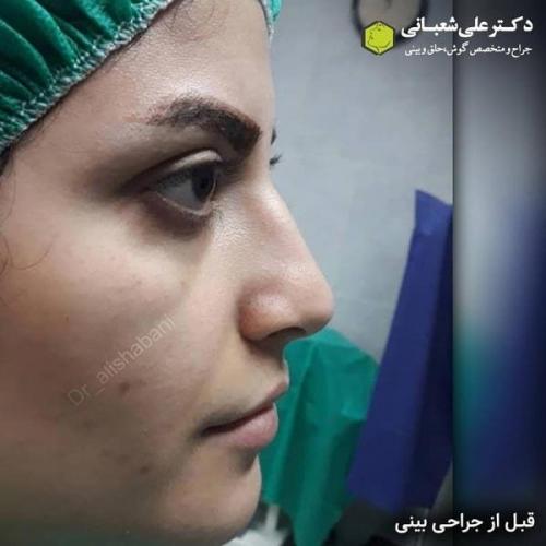جراحی بینی در بابل 81.jpg