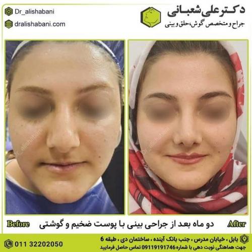 جراحی بینی در بابل 82.jpg