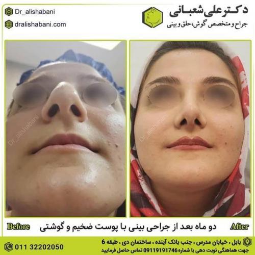 جراحی بینی در بابل 83.jpg