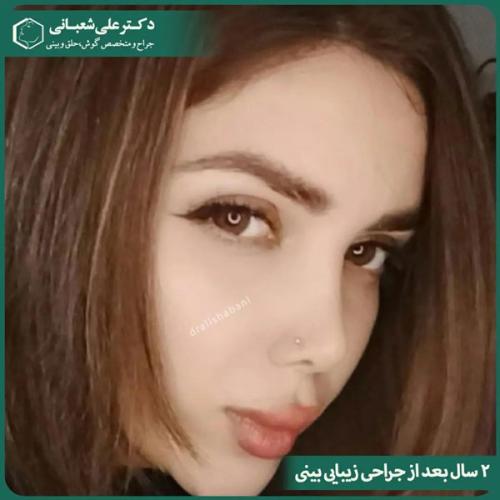 جراحی-بینی-در-بابل-475