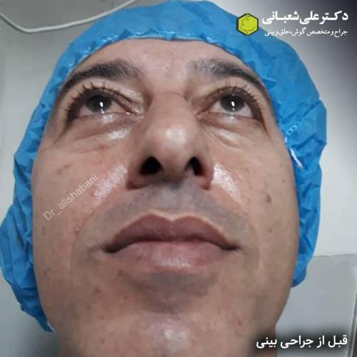 جراحی-بینی-در-بابل181