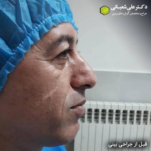 جراحی-بینی-در-بابل182
