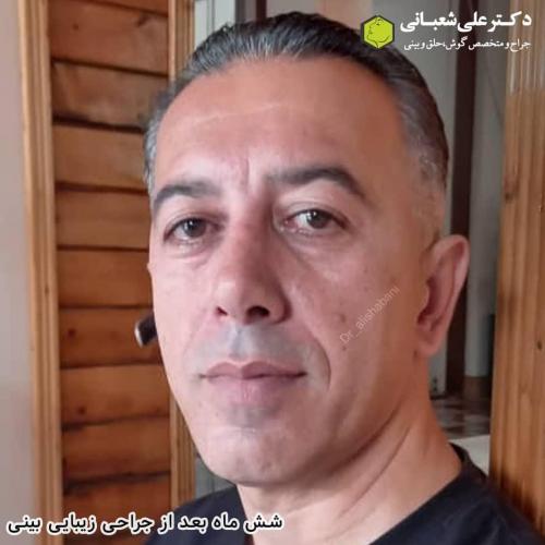 جراحی-بینی-در-بابل183