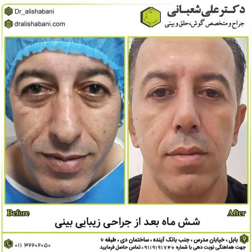جراحی-بینی-در-بابل185