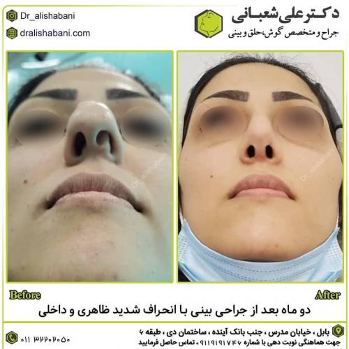 جراحی-بینی-در-بابل186
