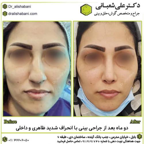 جراحی-بینی-در-بابل187