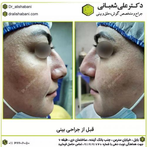 جراحی-بینی-در-بابل189